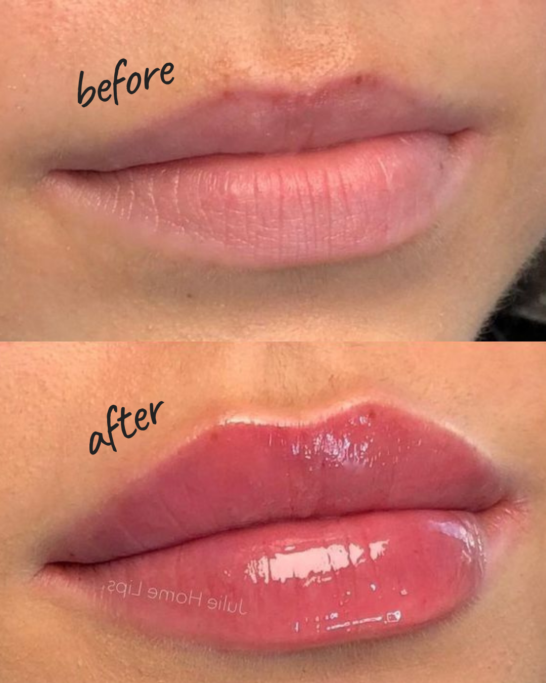 Before and After Dermal Fillers Lips Brooklyn NYC